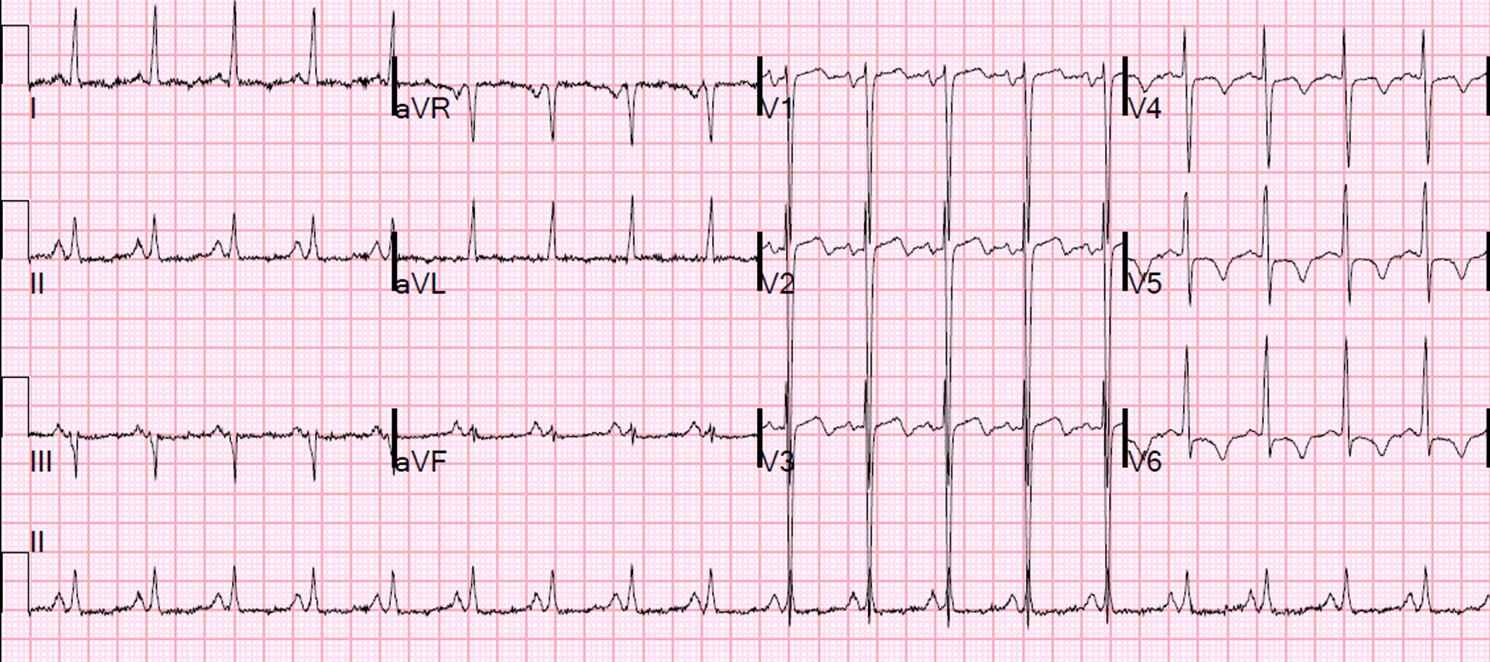how to take nitroglycerin for chest pain
